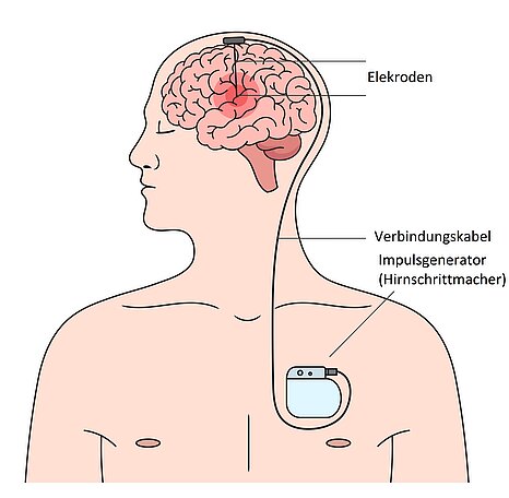 Grafik: Tiefe Stimulation durch Hirnschrittmacher