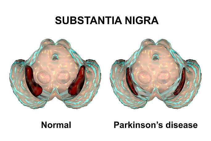 Substantia nigra in gesundem sowie an Parkinson erkrankten Gehirn, Abbildung