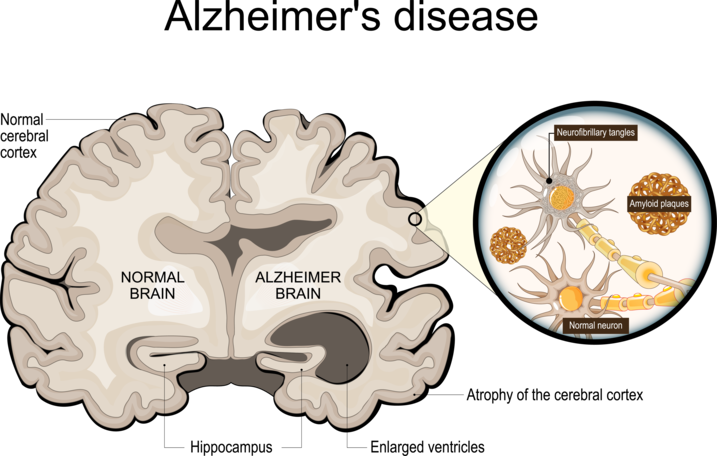 Grafik links: gesundes Gehirn; rechts: Gehirn mit Alzheimer